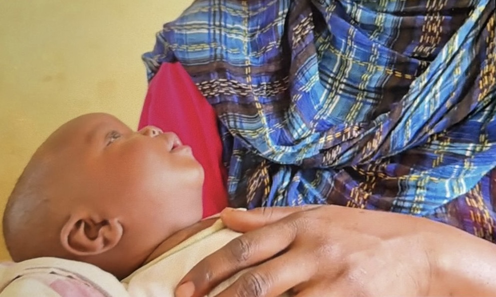 تفشي الحصبة يهدد بانهيار القطاع الصحي في شرق دارفور